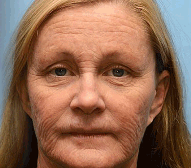 Official Store | Rejuvenate Your Skin Instantly ๐ซ STDEIยฎ BOTOX & VITA A RETINOL SHOT Anti-Wrinkle Lifting & Firming Cream