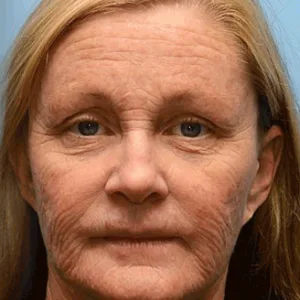 (STDEIยฎ Official Store) ๐ STDEIยฎ Botox & Vitamin A Retinol Shot Anti-Wrinkle Firming Cream - Now 50% Off in the Year-End Sale!๐ฅ