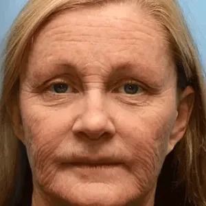 uk ๐ถ๐๐๐๐๐๐๐ ๐บ๐๐๐๐๐ฉโโ๏ธ๐| Regain youthful skin nown ๐ซSTDEIยฎ BOTOX & VITA A RETINOL SHOT Wrinkle Lift Tightening Cream